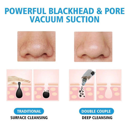 Pro-Grade Deep Pore Extraction Wand